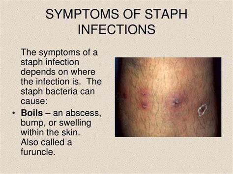 Staph Infection Images