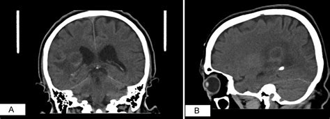 Brain Abscess In A Patient With Chronic Sinusitis Bmj Case Reports