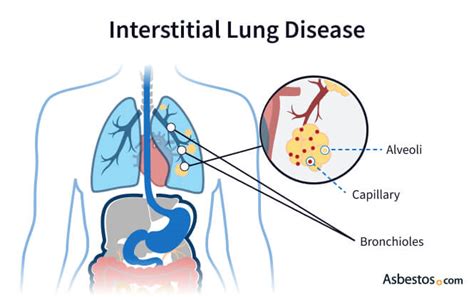Interstitial Lung Disease Link Between Asbestos Ild