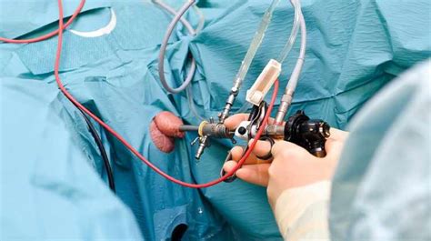 TURP Surgery Cost Hospitals Surgeons In Germany