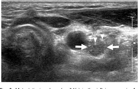 Figure 2 From Ultrasound Based Diagnosis For The Cervical Lymph Nodes