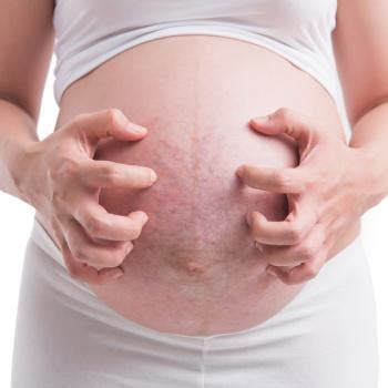 Itchy Stretch Marks: Causes, Symptoms, And Tips | Mustela USA