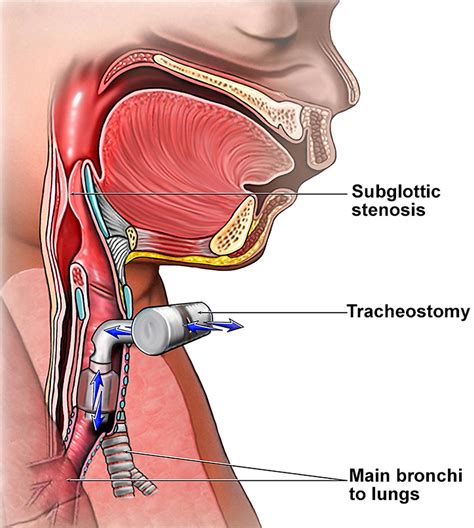 Tracheostomy Procedure Care Tracheostomy Complications