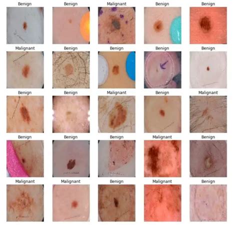 Pdf Classification Of Skin Cancer Images Using Tensor Vrogue Co