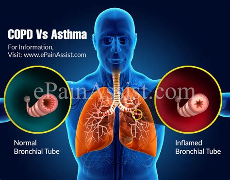 An asthma specialist, called a pulmonologist; COPD Vs Asthma: Differences Worth Knowing