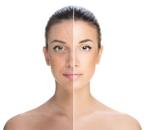 How To Fade Age Spots On Your Face Fair And Flawless