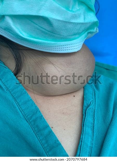 Extremely Large Neck Lump Diagnosis Multi Foto Stock 2070797684