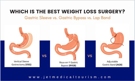 Gastric Sleeve Vs Bypass Vs Lap Band Which Is Best Weight Loss Surgery