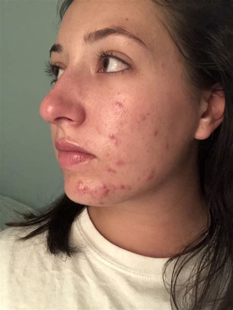 How I Cleared My Cystic Acne Daily With Dani A Life And Style Blog 3
