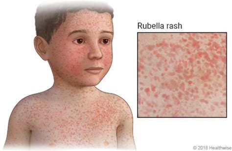 Nakakahawa Ba Ang Tigdas Hangin O German Measles