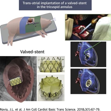 Transcatheter Tricuspid Valve Implantation Of Navigate Bioprosthesis In