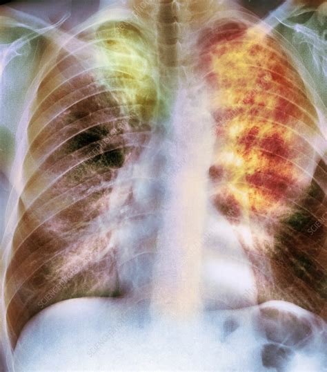 Old And New Tuberculosis X Ray Stock Image C0072667 Science