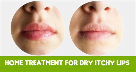Excellent Home Treatment For Dry Itchy Lips 13 Best Methods