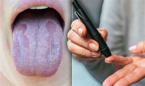 Diabetes Type 2 Warning Does Your Mouth Taste Like This The Nasty Sign To Look Out For