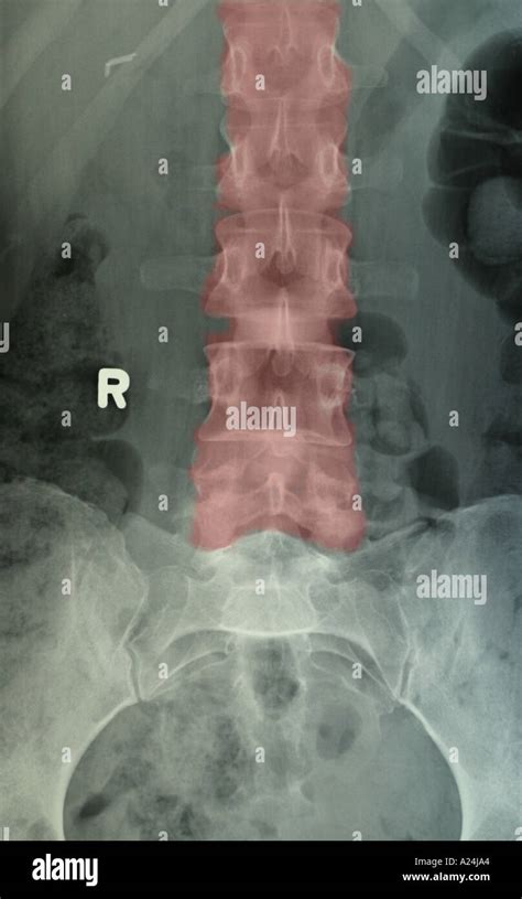 Radiografía De La Columna Vertebral Fotografía De Stock Alamy