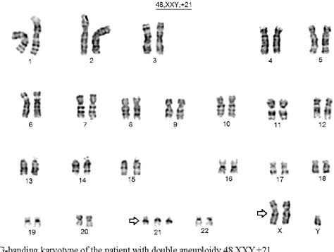 Pdf Down Klinefelter Syndrome Xxy In A Neonate Associated