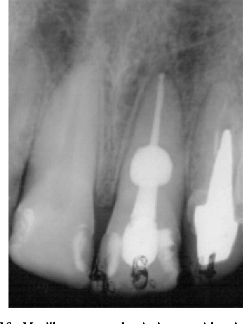 Figure 19 From Internal Inflammatory Root Resorption The Unknown
