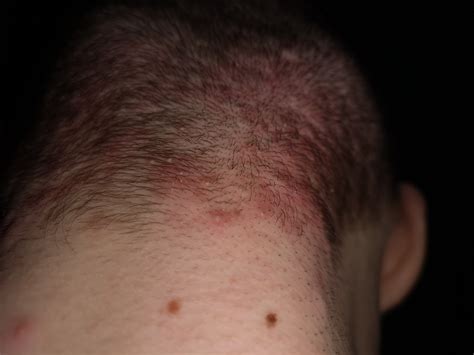 Heftiger Kopfhautausschlag Follikulitis Haarbalgentzündung