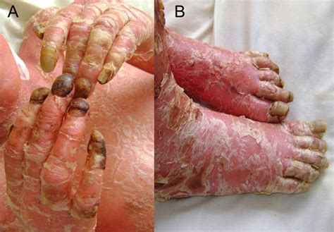 A Severe Case Of Erythrodermic Psoriasis Associated With Advanced Nail
