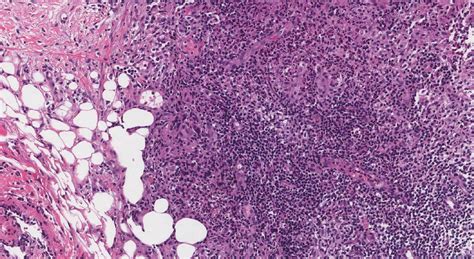 Cystic Neutrophilic Granulomatous Mastitis Atlas Of Pathology