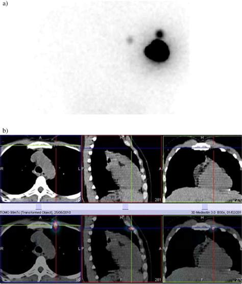 Lymphoscintigraphy Can Select Breast Cancer Patients For Internal