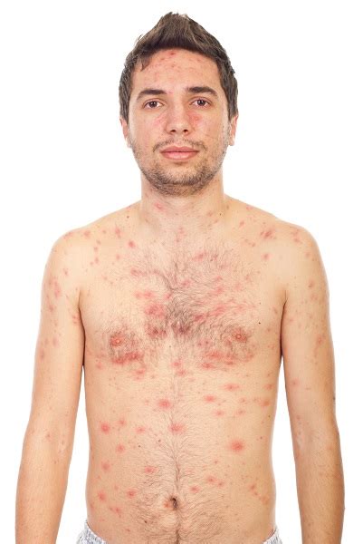 13 Common Skin Rashes That Can Occur To Any Body