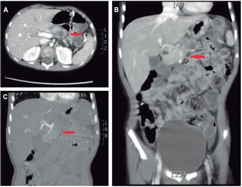 Pancreatoblastoma Case Report And Review Of Literature