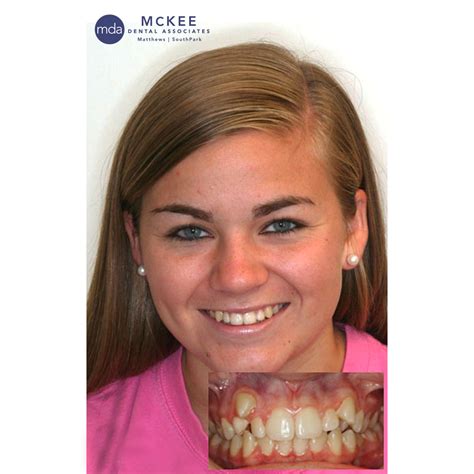 Braces To Straighten Teeth And Close Spaces Mckee Dental Associates