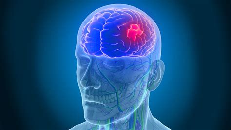 Electrical Stimulation Promising In Acute Ischemic Stroke