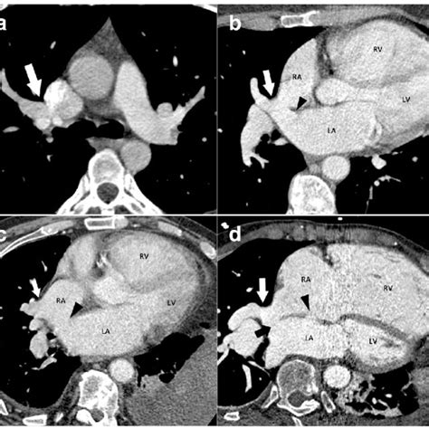 Normal Pulmonary Venous Anatomy And Normal Variants 3d Ct