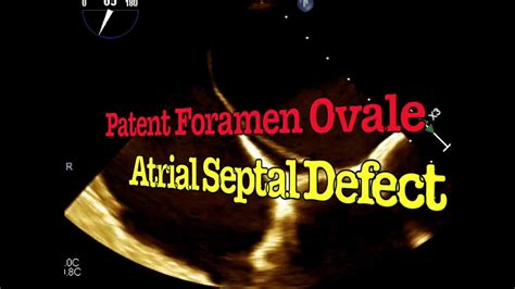 Patent Foramen Ovale Pfo And Atrial Septal Defect Asd Youtube