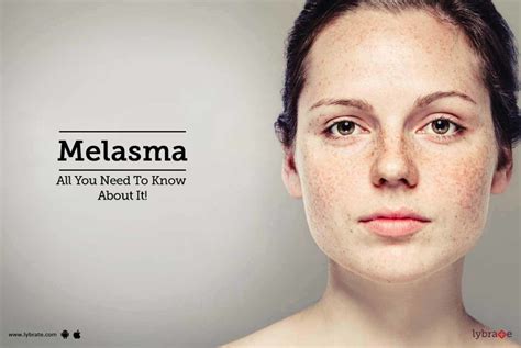 Melasma All You Need To Know About It By Dr Vidula Kamath Lybrate
