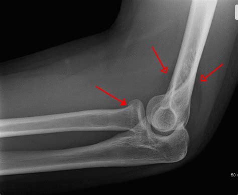 Radial Head Fractures Clinical Features Management Teachmesurgery