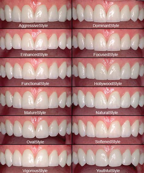 Choosing The Perfect Shaped Porcelain Veneers Gorbatov Dentistry