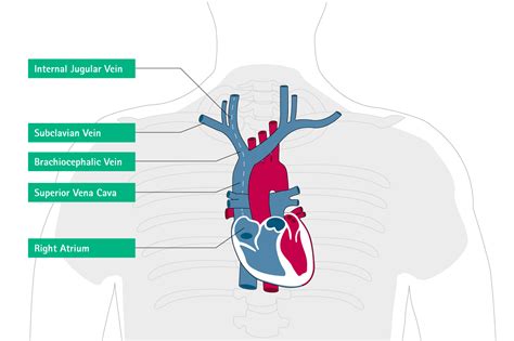 Misplacement And Malposition Of Central Venous Catheters