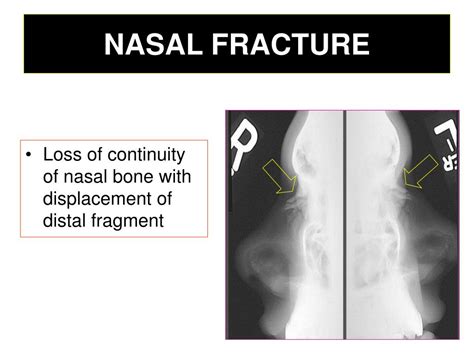 Usually from direct blow during athletics, motor vehicle collision or an altercation there may be lucencies that are normally seen that traverse the nasal bones longitudinally. PPT - Radiology of The Ear PowerPoint Presentation, free ...