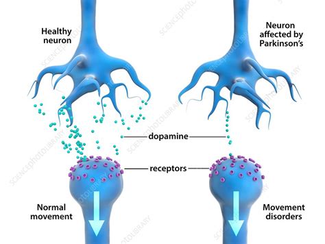 Parkinsons Disease Dopaminergic Neurons Captions Update Trendy