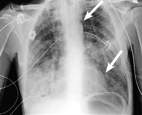 Anteriorposterior Chest Radiograph Displaying Lucency Adjacent To The