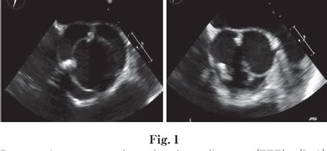 Figure 1 From Bicuspidization Of The Unicuspid Aortic Valve By