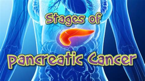Stages Of Pancreatic Cancer