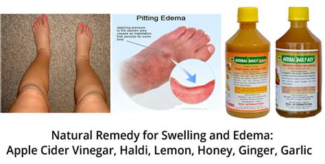 Natural Swelling And Edema Treatment