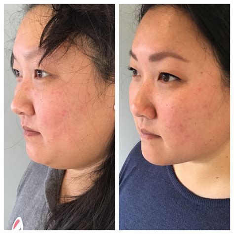 Kybella Before And After Img1339 1 Mpls Anti Aging And Skin