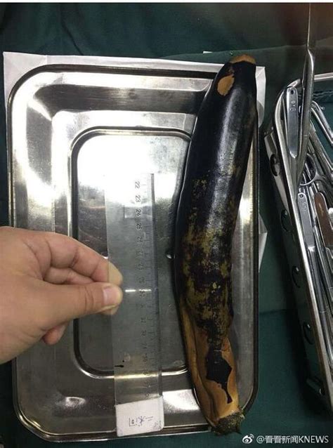 Man Inserts Giant Eggplant Up His Anus In Hopes To Cure His Constipation Dailypedia