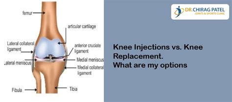 Knee Injections Vs Knee Replacement What Are My Options