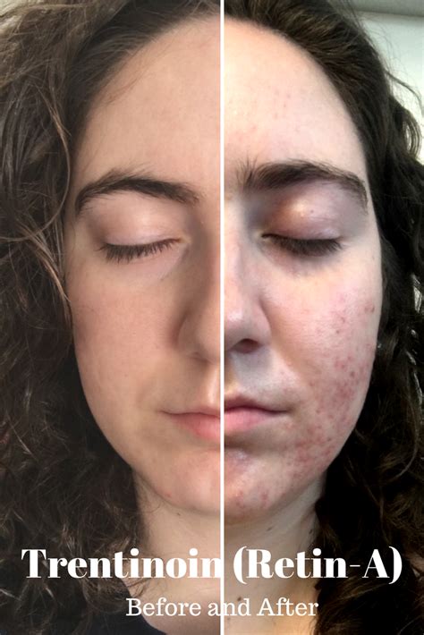 Tretinoin Retin A Before And After Acne Katie Mcmanus