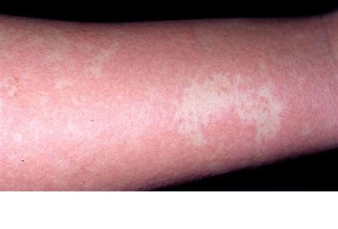 15 Adverse Cutaneous Drug Reactions
