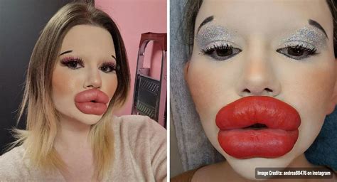 A Woman Who Has Worlds Biggest Lips Now Wants To Have Bigger Cheekbones