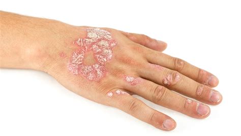 Psoriasis Vs Skin Cancer Gentlecure