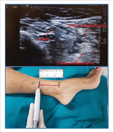 Ultrasound Guided Posterior Tibial Nerve Block In Plain Note The Image The Best Porn Website
