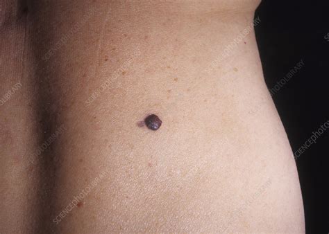 Malignant Melanoma Stock Image C Science Photo Library